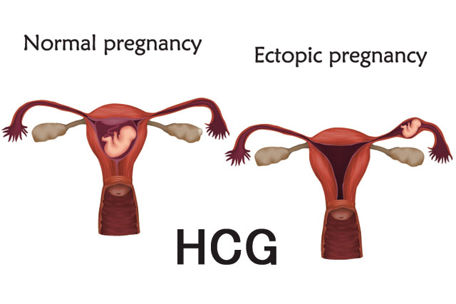 Read more about the article HCG for Ectopic Pregnancy: Diagnosis and Treatment