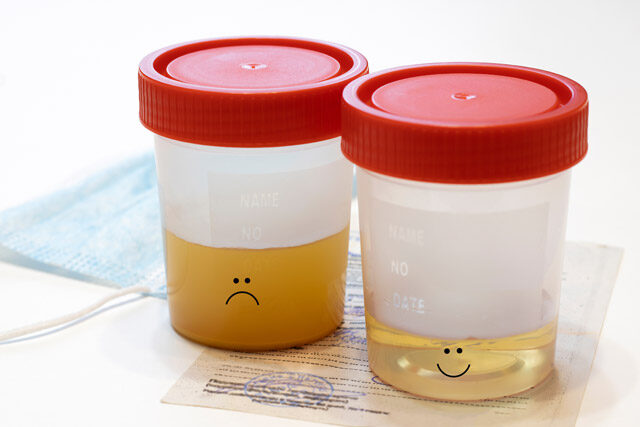 Read more about the article What Causes Cloudy Urine During Pregnancy?