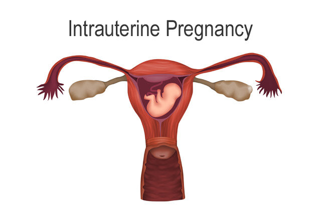 Read more about the article Intrauterine Pregnancy