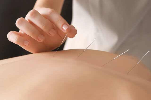 Read more about the article Does Acupuncture Work for Fertility?