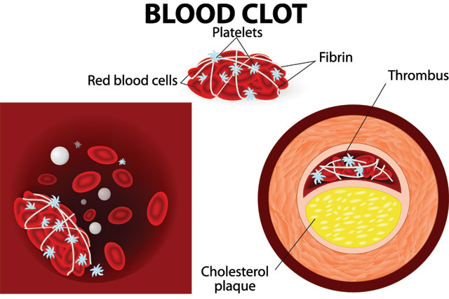 Read more about the article Pregnancy and Blood Clots: Risks Explained