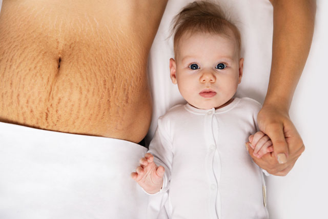 Read more about the article How to Prevent Pregnancy Stretch Marks? Useful Tips