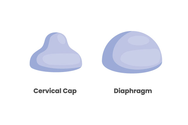 Cervical Cap Explaining The Function And Usage 9439