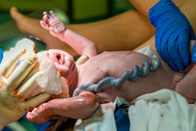 Umbilical Cord. What Happens after the Birth?