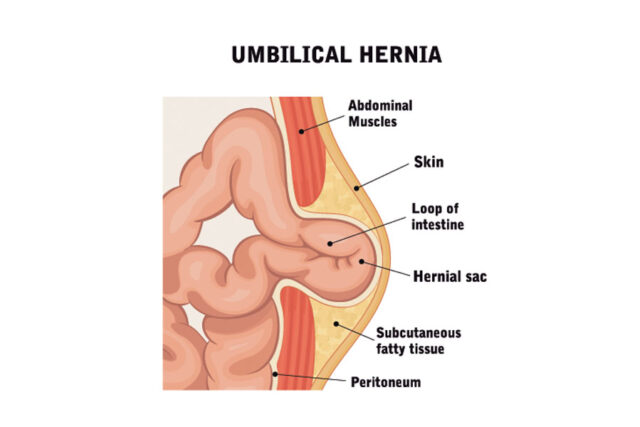 Read more about the article Things to Know about Hernia during Pregnancy